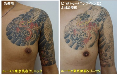 胸から腕の比較的広範囲タトゥー 黒黄色赤3色2回