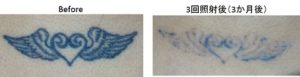 タトゥー除去ピコレーザー0048＠ルーチェクリニック
