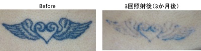 圧倒的症例数　ピコレーザー（エンライトン）によるタトゥー除去。治療3か月後