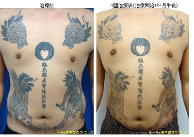 胸～腹部にかけての広範囲タトゥー