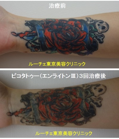 腕のカラフルなべったりと濃いタトゥーのインク　腕3回黒赤青