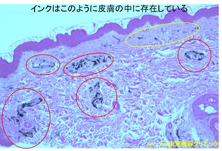 タトゥーのインクが入った皮膚の顕微鏡写真です。これを治療に活かします。