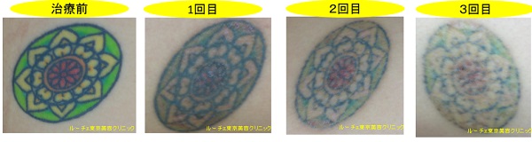 緑赤黄黒の４色カラータトゥーの４回分写真。治療経過です。