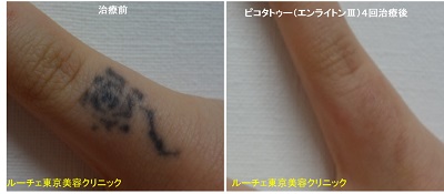 指のタトゥーがとれました。黒