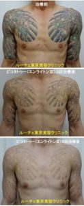 タトゥー除去ピコレーザー、6回、腕～胸、黒、緑
