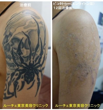 タトゥー除去ピコレーザー、12回、腕、黒