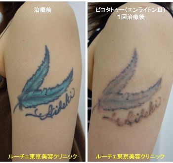 タトゥー除去ピコレーザー、1回、腕、黒、青
