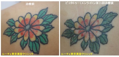 背中のカラフルなお花のタトゥー　緑黒赤黄色黄緑1回5色