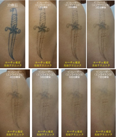 黒タトゥーの腕症例。治療終了間近までの経過８写真。
