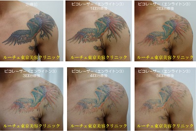 色がたくさん入ったタトゥーの治療経過写真をまとめてみました。