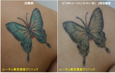 鮮やかな蝶のタトゥーが1回の治療で薄くなりました