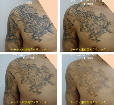 肩～胸の広範囲タトゥーはこう消えていく　タトゥー１色（黒）の経過