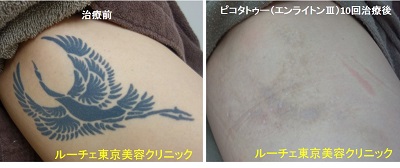 大腿の黒くべったりと濃いタトゥーが目立たなくなりました　10回