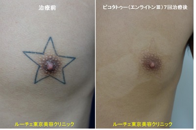 胸の星型タトゥーが7回の治療でインクが取れました。