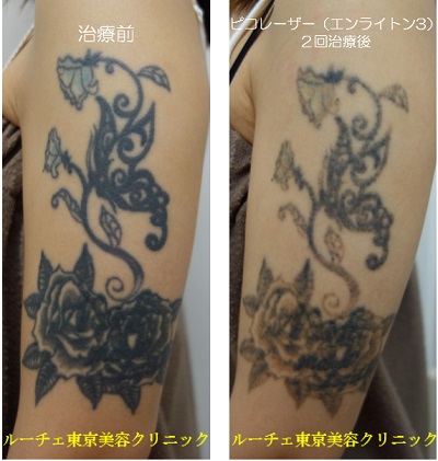 青・黒2色腕のタトゥー