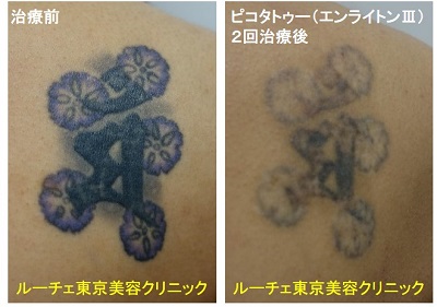 タトゥー除去ピコレーザー、2回、背中、黒、紫