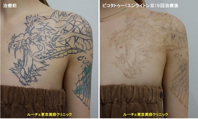 タトゥー除去ピコレーザー、胸～腕、黒、水色、緑