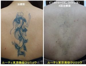 タトゥー除去ピコレーザー、背中、黒