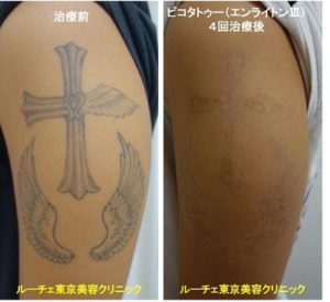 タトゥー除去ピコレーザー、4回、腕、黒