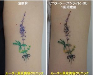 タトゥー除去ピコレーザー、1回、腕、黒、緑、黄緑、紫