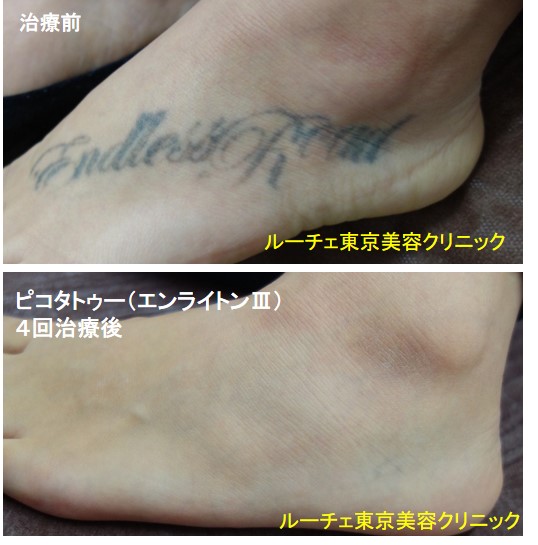 タトゥー除去ピコレーザー、4回、足、黒