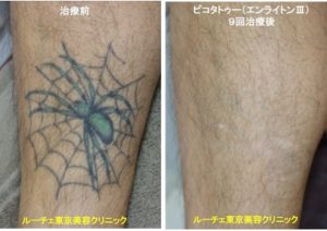 タトゥー除去ピコレーザー、足、黒、緑