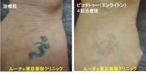 タトゥー除去ピコレーザー、4回、手の甲、黒