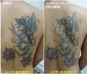 タトゥー除去ピコレーザー、2回、背中、黒、赤、緑、水色、オレンジ