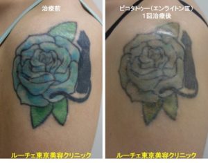 タトゥー除去ピコレーザー、1回、腕、黒、水色、緑
