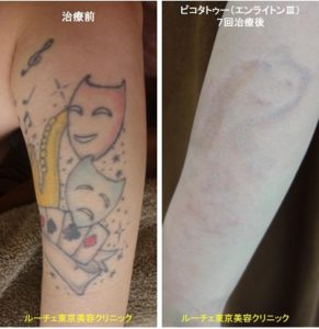 タトゥー除去ピコレーザー、腕、黒、黄色、水色、赤