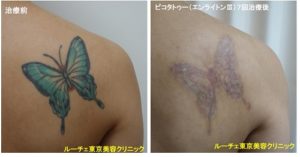 タトゥー除去ピコレーザー、7回、背中、黒、緑、黄色、赤