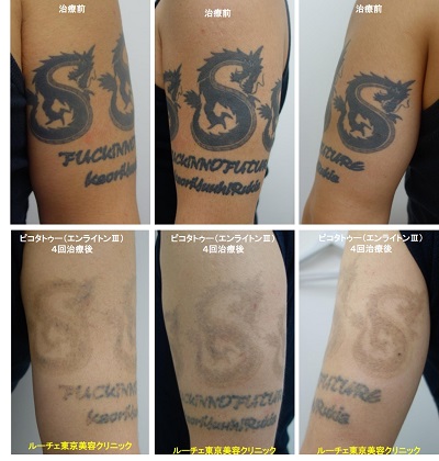 タトゥー除去ピコレーザー、4回、腕、黒