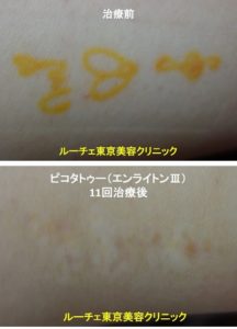 タトゥー除去ピコレーザー、11回、足、黄色