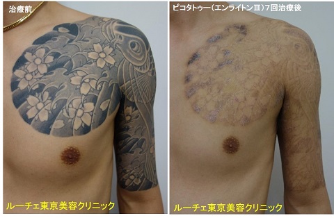 タトゥー除去ピコレーザー、7回、腕～胸、黒