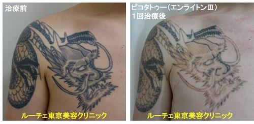 タトゥー除去ピコレーザー、1回、腕～胸、黒