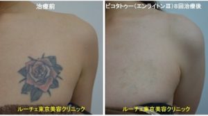 タトゥー除去ピコレーザー、8回、胸、黒、赤、黄色、緑