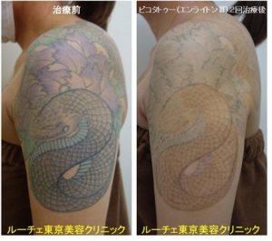 タトゥー除去ピコレーザー、2回、腕、黒、紫、緑、水色