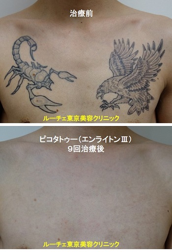 タトゥー除去ピコレーザー、9回、胸、黒