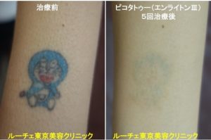 タトゥー除去ピコレーザー、腕、5回、黒、青、赤