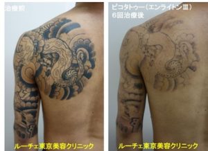 タトゥー除去ピコレーザー、6回、背中～腕、黒