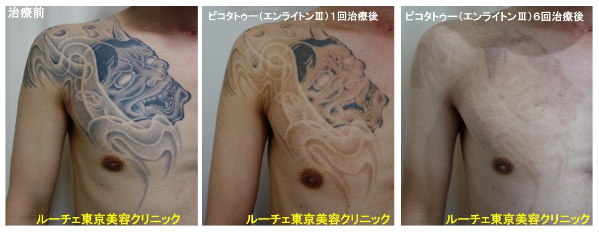 タトゥー除去ピコレーザー、６回、胸、黒