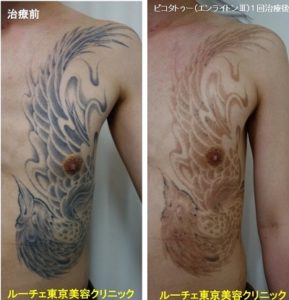 タトゥー除去ピコレーザー、1回、胸～腹、黒