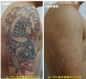 タトゥー除去ピコレーザー、8回、腕、黒、赤、黄色