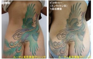 タトゥー除去ピコレーザー、1回、背中、緑、黄色、赤、黒