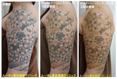 タトゥー除去ピコレーザー、2回、腕、黒