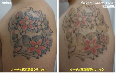 タトゥー除去ピコレーザー、1回、腕、黒、赤、黄色、緑