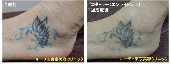 タトゥー除去ピコレーザー、1回、足、黒、水色