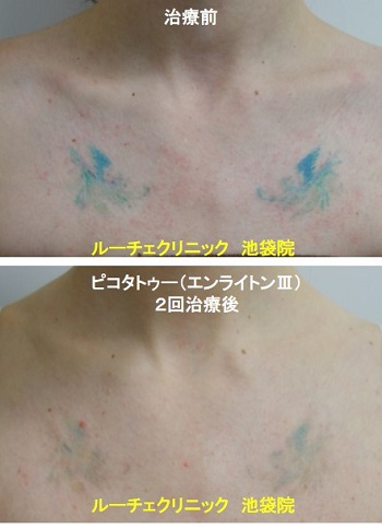 タトゥー除去ピコレーザー、胸、2回、青、緑、黄緑