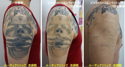 タトゥー除去ピコレーザー、腕、7回、黒