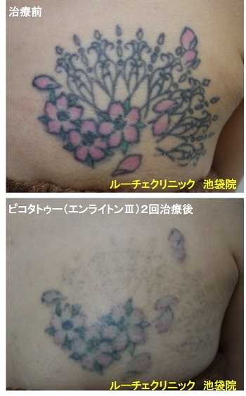 タトゥー除去ピコレーザー、胸、２回、黒、ピンク、緑
